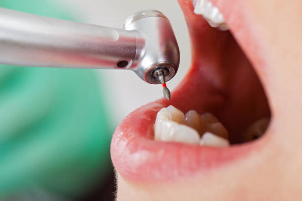 Best Emergency Tooth Extraction in Moriarty, NM